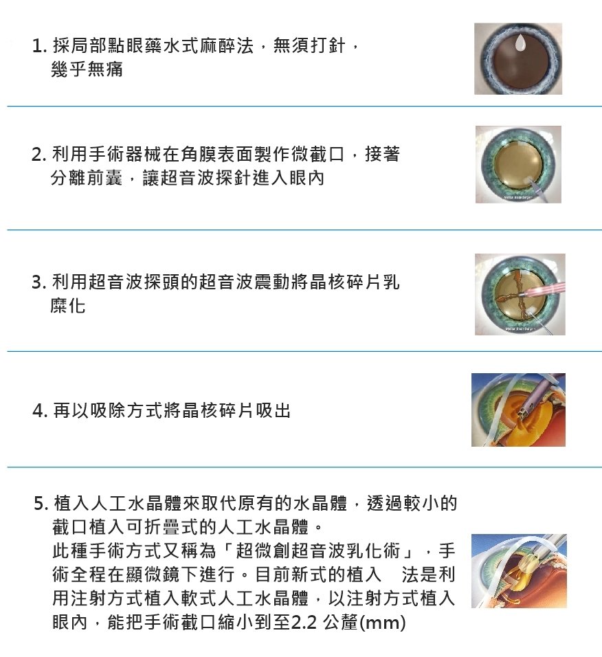 手術介紹 老花近視雷射 新竹大學眼科診所