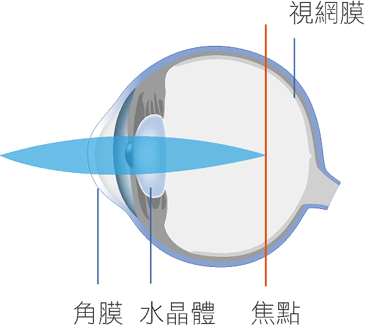 近視眼球