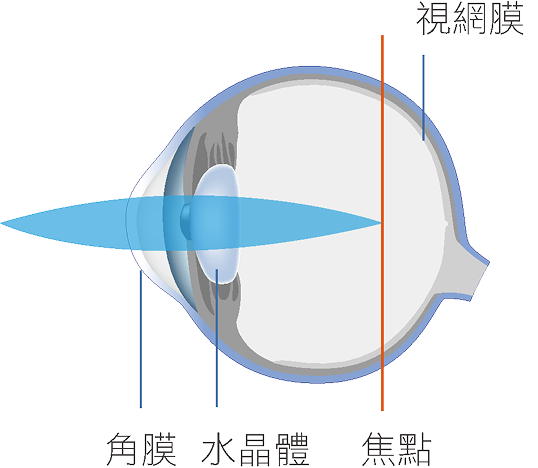 近視眼球