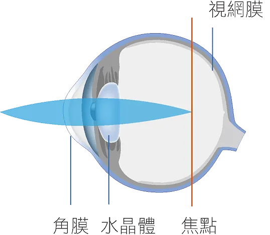 近視眼球