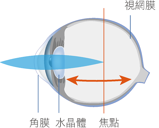 高度近視眼球
