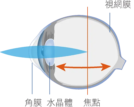 高度近視眼球