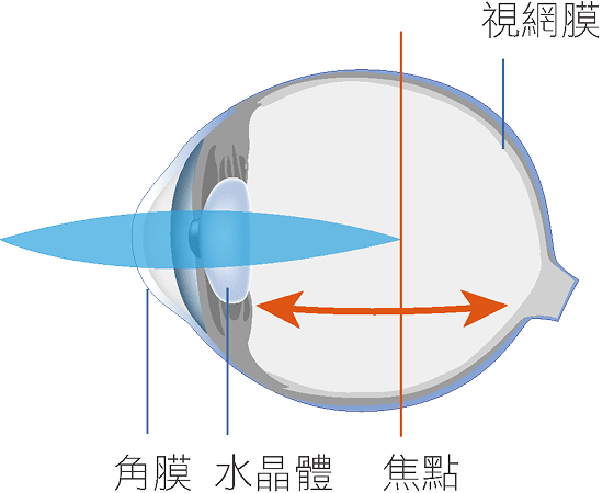 高度近視眼球