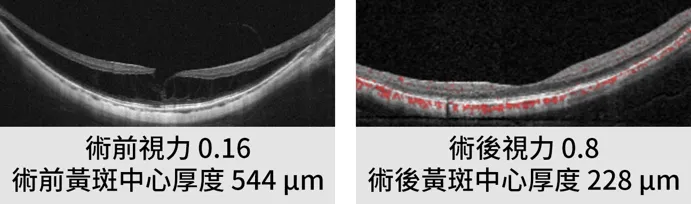 高度近視黃斑部牽引症治療