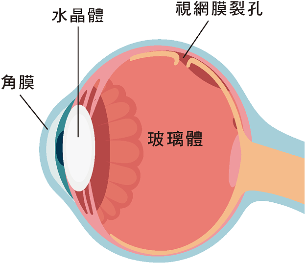 視網膜裂孔
