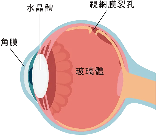 視網膜裂孔