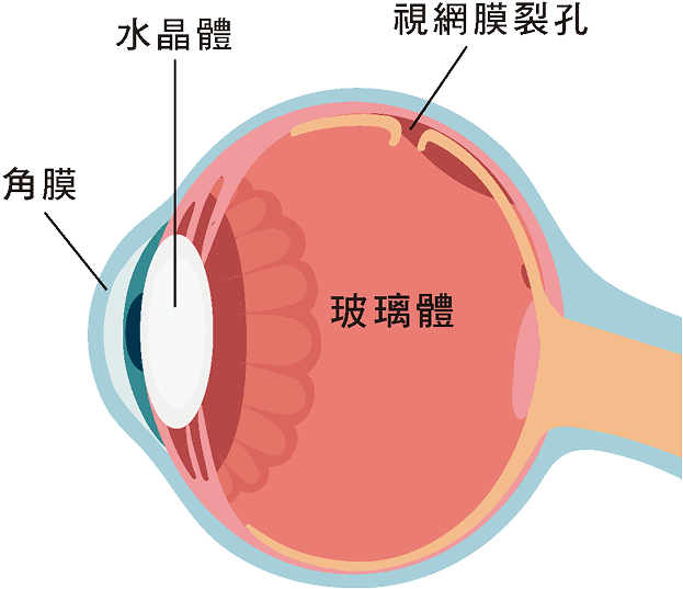 視網膜裂孔