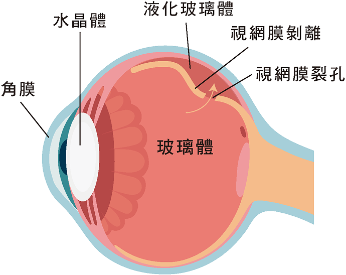 視網膜剝離