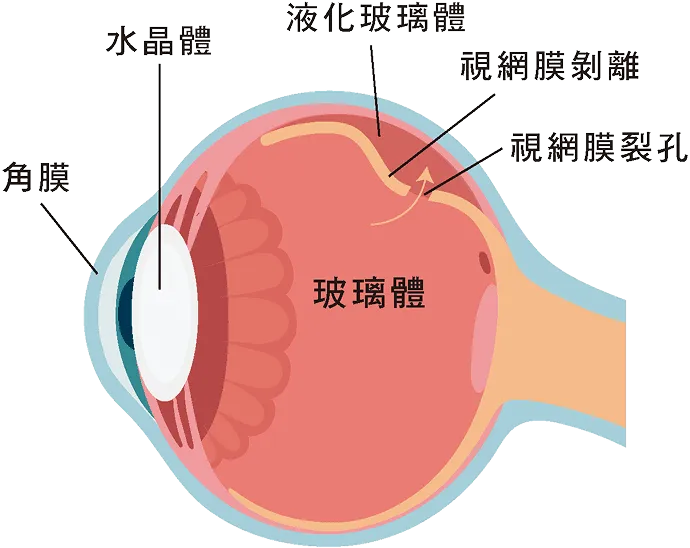 視網膜剝離