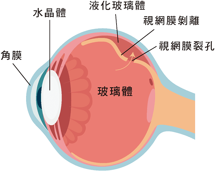 視網膜剝離
