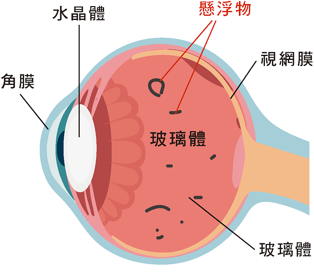 飛蚊症眼球