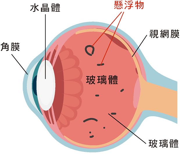飛蚊症眼球