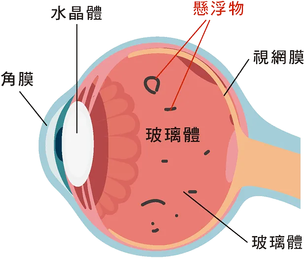 飛蚊症眼球