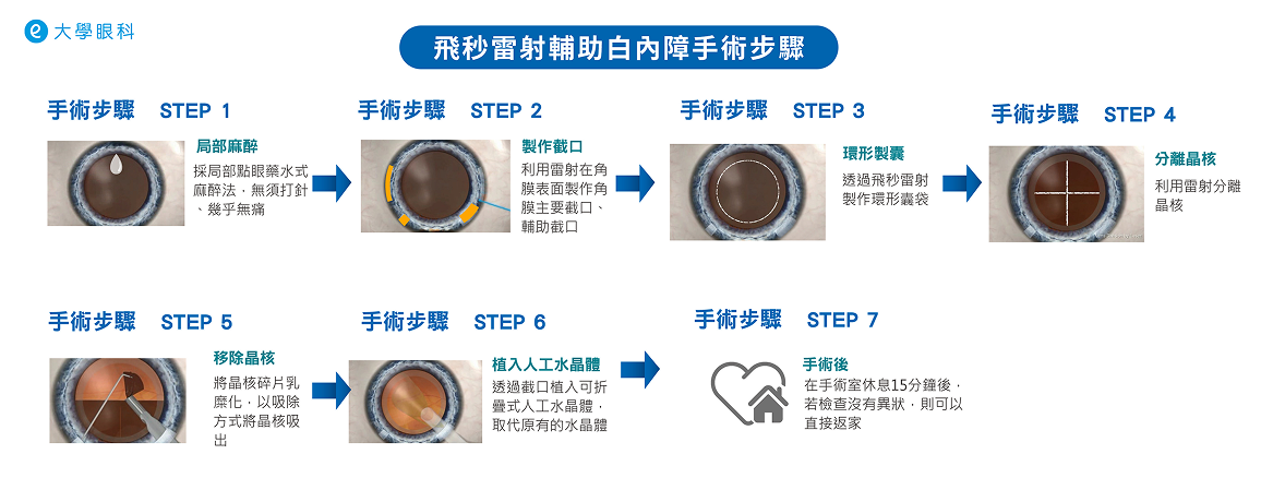 飛秒雷射輔助白內障手術
