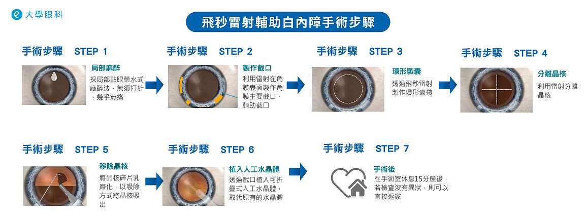 飛秒雷射輔助白內障手術