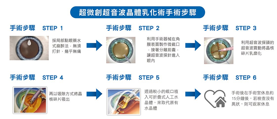 超微創超音波乳化術手術過程