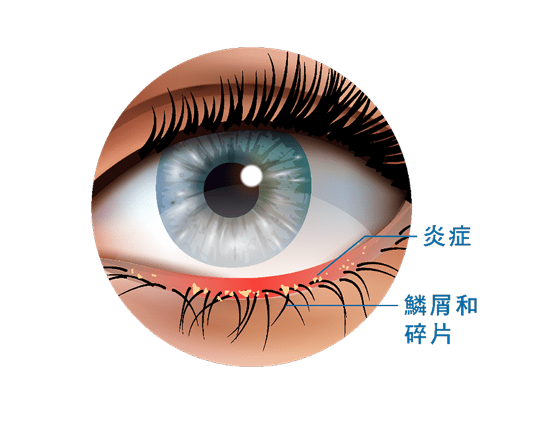 眼瞼炎