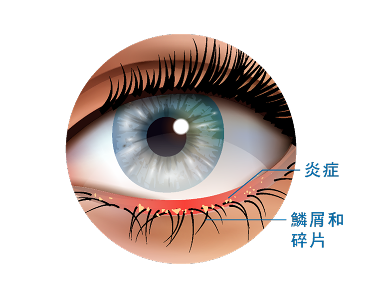 眼瞼炎