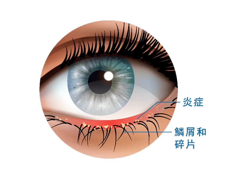 眼瞼炎