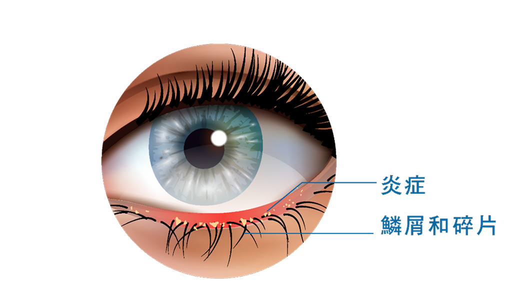 眼瞼炎