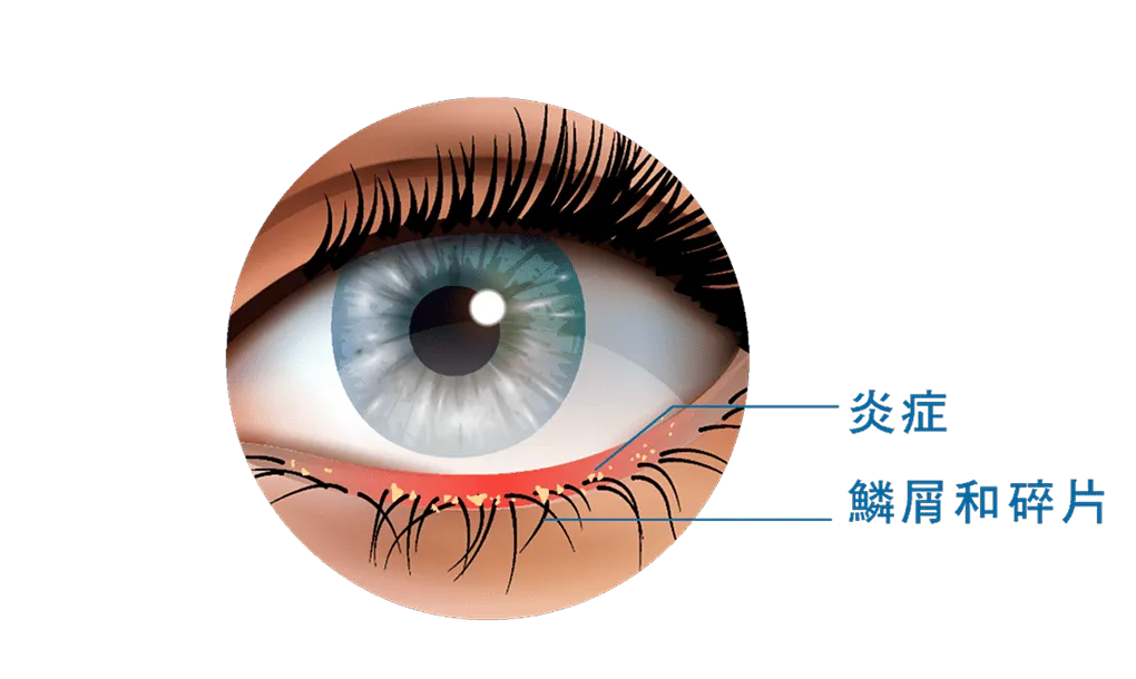 眼瞼炎