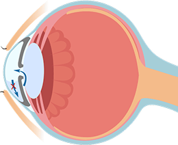 房水無法正常排出