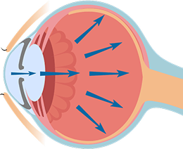 房水累積使眼壓升高