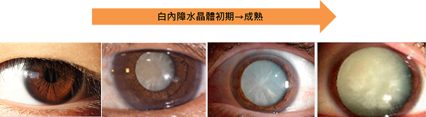 林鴻源醫師白內障教學