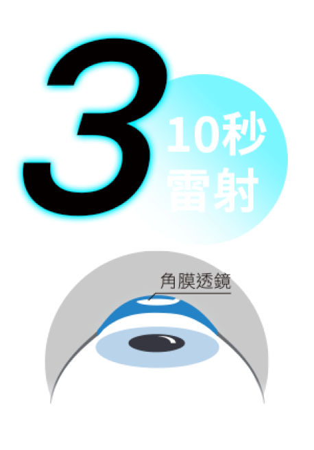 角膜表面下方利用全飛秒,雷射出超薄專利透鏡。