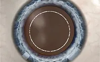 STEP 3 環形製囊