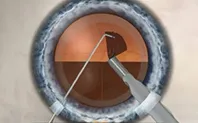 STEP 5 移除晶核