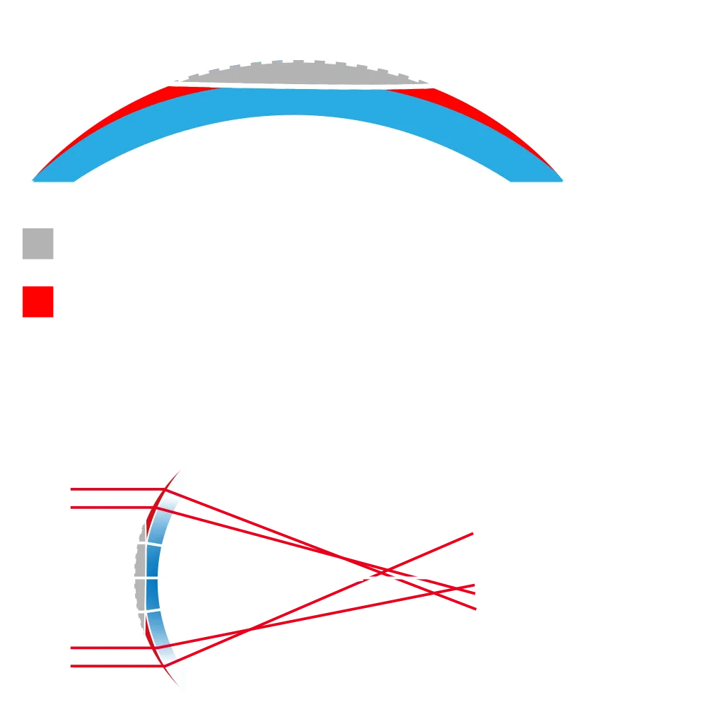 未使用前導波像差優化系統消除度數