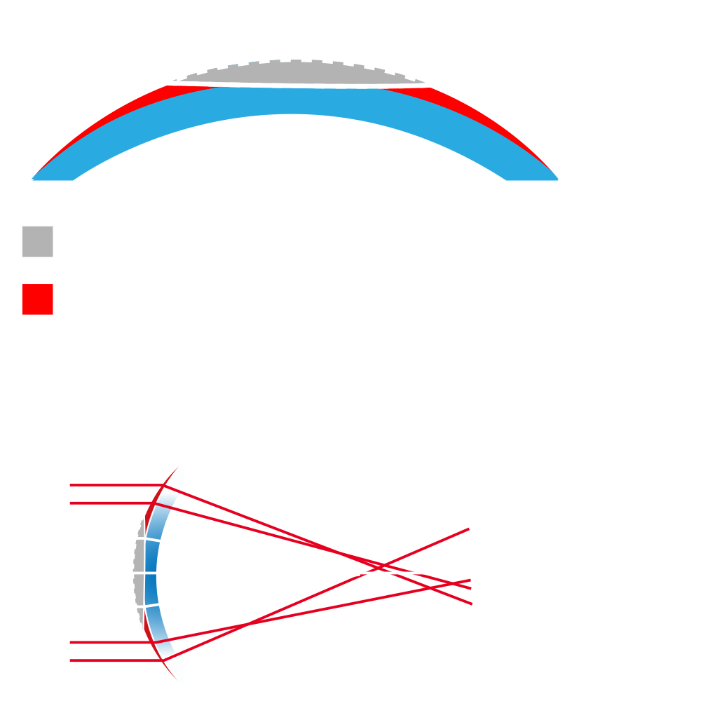 未使用前導波像差優化系統消除度數