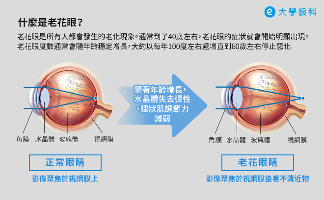 什麼是老花眼