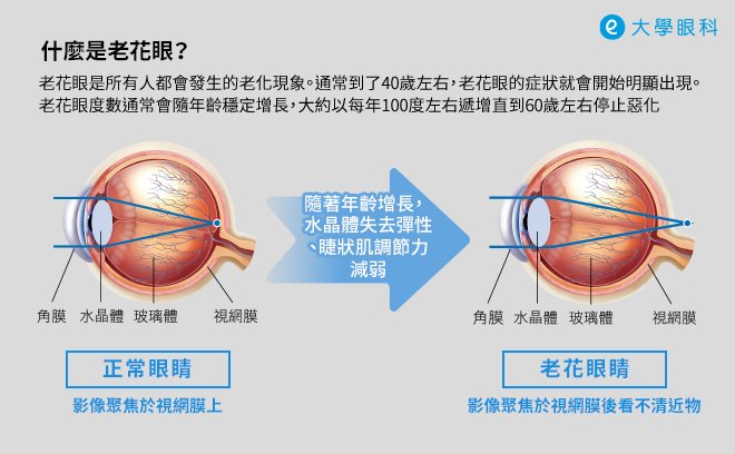 什麼是老花眼