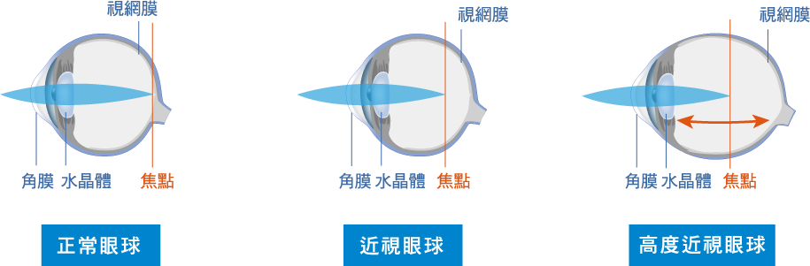 正常眼球、近視眼球、高度近視眼球